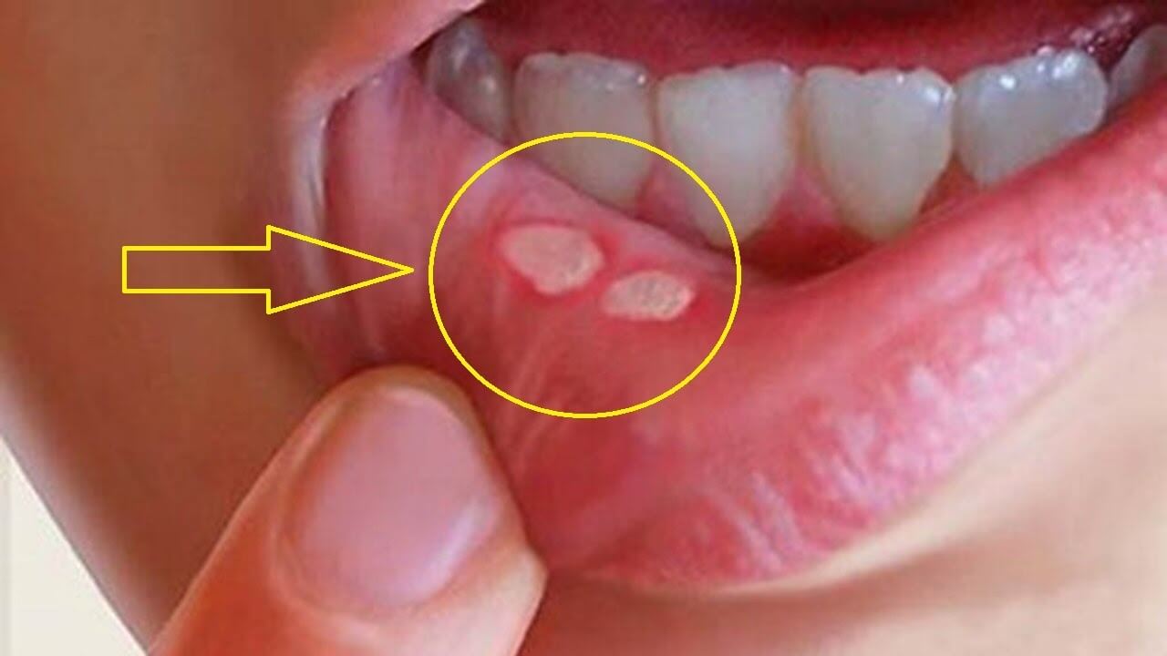 Mẹo hay chữa bệnh nhiệt miệng tại nhà, hiệu quả 1