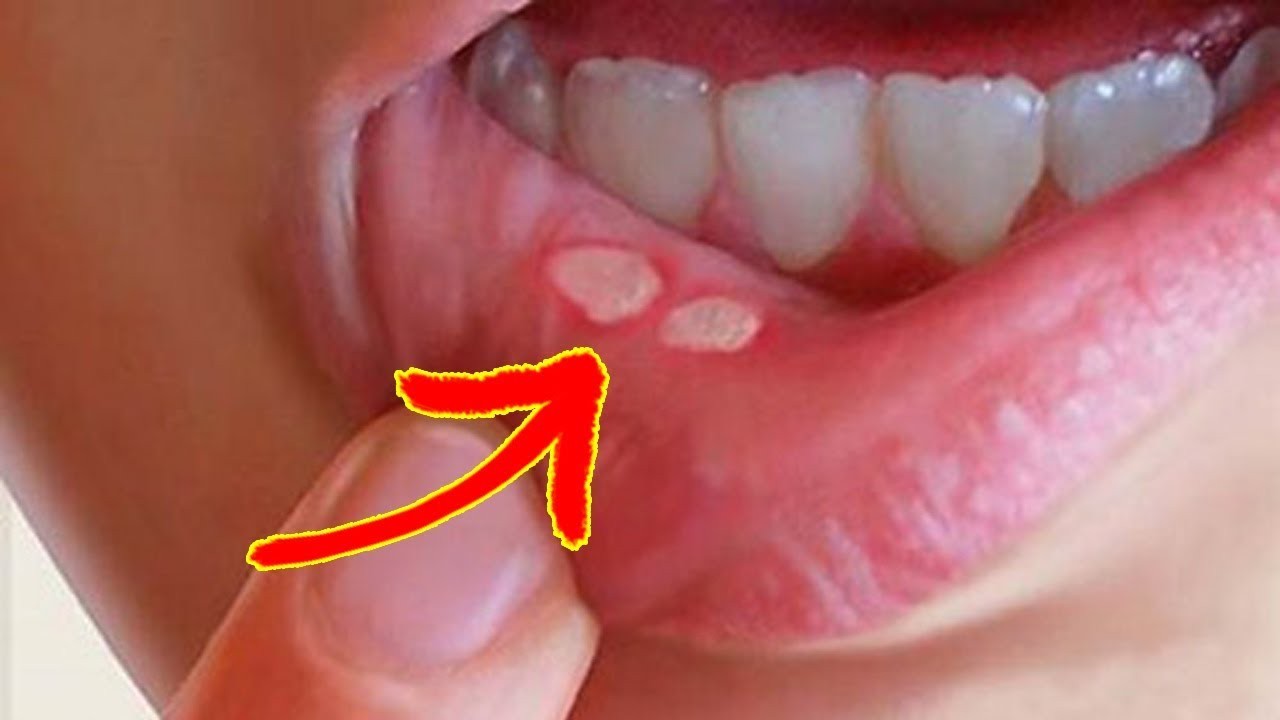 Nguyên nhân và cách phòng ngừa bệnh nhiệt miệng 1