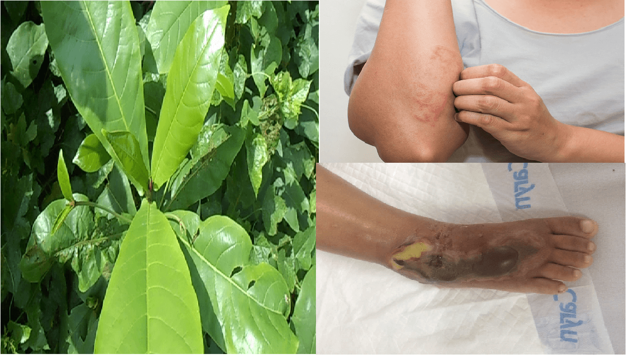 Những bài thuốc chữa bệnh từ lá bàng mà không phải ai cũng biết 3